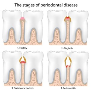 periodontal disease